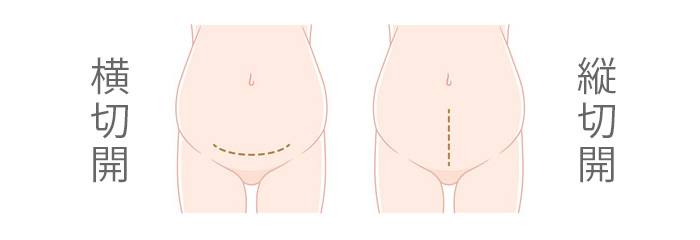 帝王切開の傷跡の種類